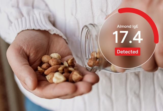 Tree Nut Allergy Panel with Reflex to Components number 2